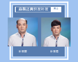 阿勒泰青海织发补发帮您解决脱发烦恼